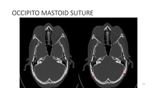 OCCIPITO MASTOID SUTURE
226
 
