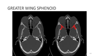 GREATER WING SPHENOID
228
 