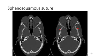 Sphenosquamous suture
229
 