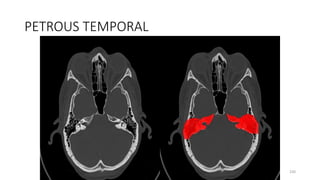 PETROUS TEMPORAL
230
 
