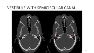 VESTIBULE WITH SEMICIRCULAR CANAL
232
 