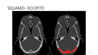 SQUAMO- OCCIPITO
234
 