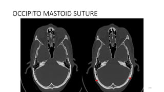 OCCIPITO MASTOID SUTURE
235
 