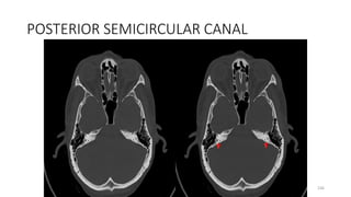 POSTERIOR SEMICIRCULAR CANAL
236
 