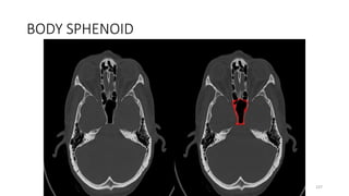 BODY SPHENOID
237
 