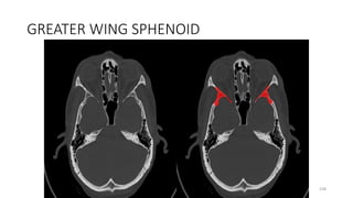 GREATER WING SPHENOID
238
 