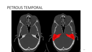 PETROUS TEMPORAL
240
 