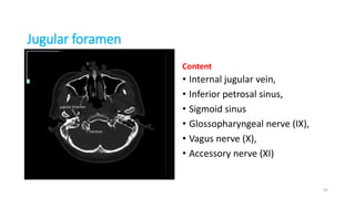 Jugular foramen
Content
• Internal jugular vein,
• Inferior petrosal sinus,
• Sigmoid sinus
• Glossopharyngeal nerve (IX),
• Vagus nerve (X),
• Accessory nerve (XI)
45
 