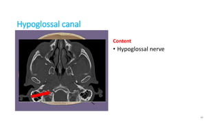 Hypoglossal canal
Content
• Hypoglossal nerve
46
 