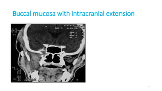 Buccal mucosa with intracranial extension
5
 