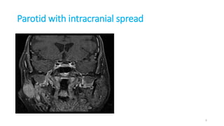 Parotid with intracranial spread
6
 