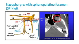 Nasopharynx with sphenopalatine foramen
(SPf) left
7
 