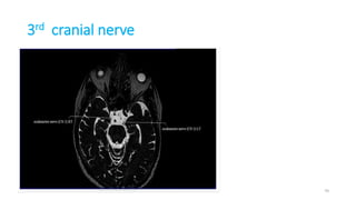 3rd cranial nerve
70
 