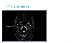 4th cranial nerve
71
 