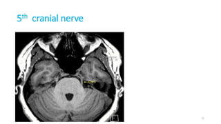 5th cranial nerve
72
 