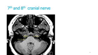 7th and 8th cranial nerve
74
 
