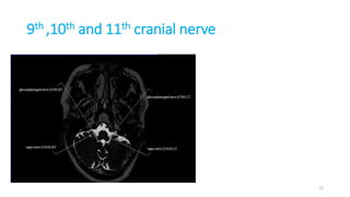9th ,10th and 11th cranial nerve
75
 