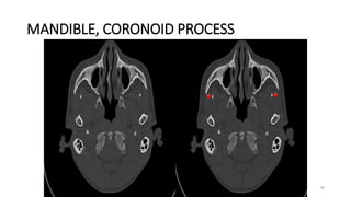 MANDIBLE, CORONOID PROCESS
79
 