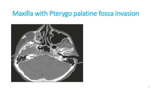 Maxilla with Pterygo palatine fossa invasion
8
 