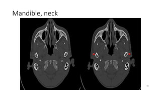 Mandible, neck
80
 