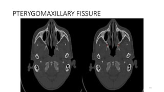 PTERYGOMAXILLARY FISSURE
83
 