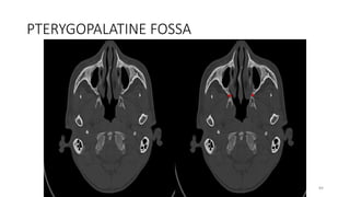 PTERYGOPALATINE FOSSA
84
 
