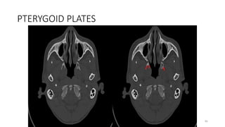 PTERYGOID PLATES
85
 