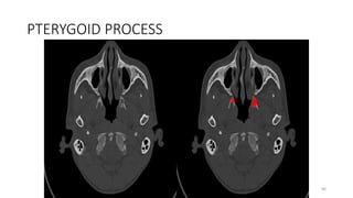 PTERYGOID PROCESS
86
 