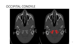 OCCIPITAL CONDYLE
91
 