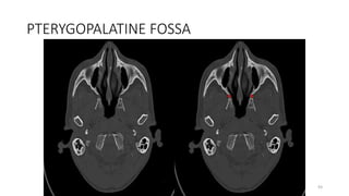 PTERYGOPALATINE FOSSA
93
 