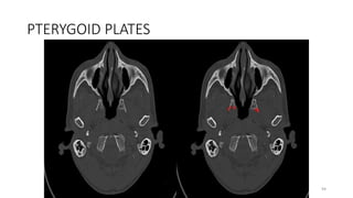 PTERYGOID PLATES
94
 