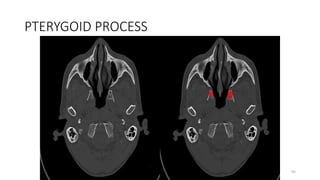 PTERYGOID PROCESS
95
 