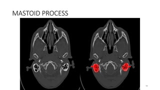 MASTOID PROCESS
98
 