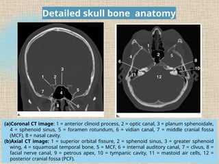 skull base related lesions in routine CT Brain | PPTX