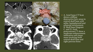 Skull base tumors & perineural spread radiology ppt | PPTX