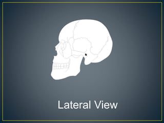 Lateral Skull Fracture