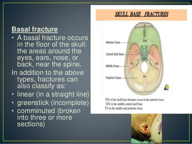 Skull Fractures
