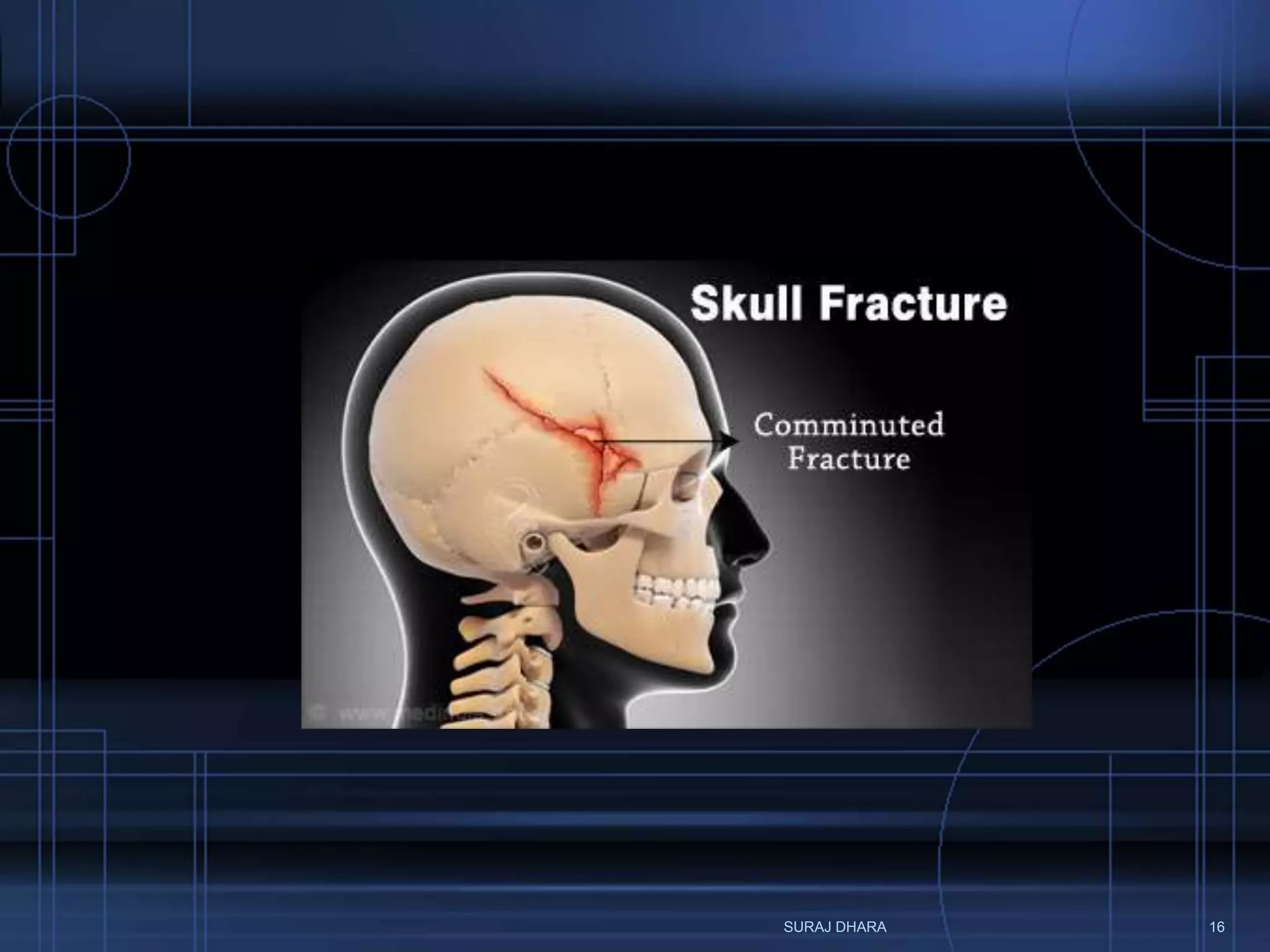 What Part Of Your Skull Can Survive A Hit? - yzutqv9