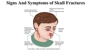 Signs And Symptoms of Skull Fractures
 