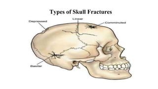 Types of Skull Fractures
 