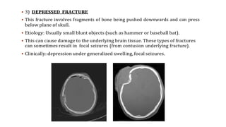  3) DEPRESSED FRACTURE
 This fracture involves fragments of bone being pushed downwards and can press
below plane of skull.
 Etiology: Usually small blunt objects (such as hammer or baseball bat).
 This can cause damage to the underlying brain tissue. These types of fractures
can sometimes result in focal seizures (from contusion underlying fracture).
 Clinically: depression under generalized swelling, focal seizures.
 