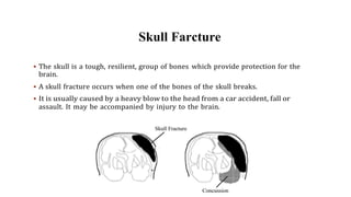 Types of Skull Fractures
 