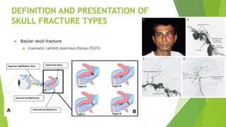 Skull fractures in adults | PPT