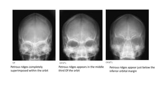 Peratal Ridge Skull,orbit temporal bones,facial bones,paranasal sinuses,mandible and ...