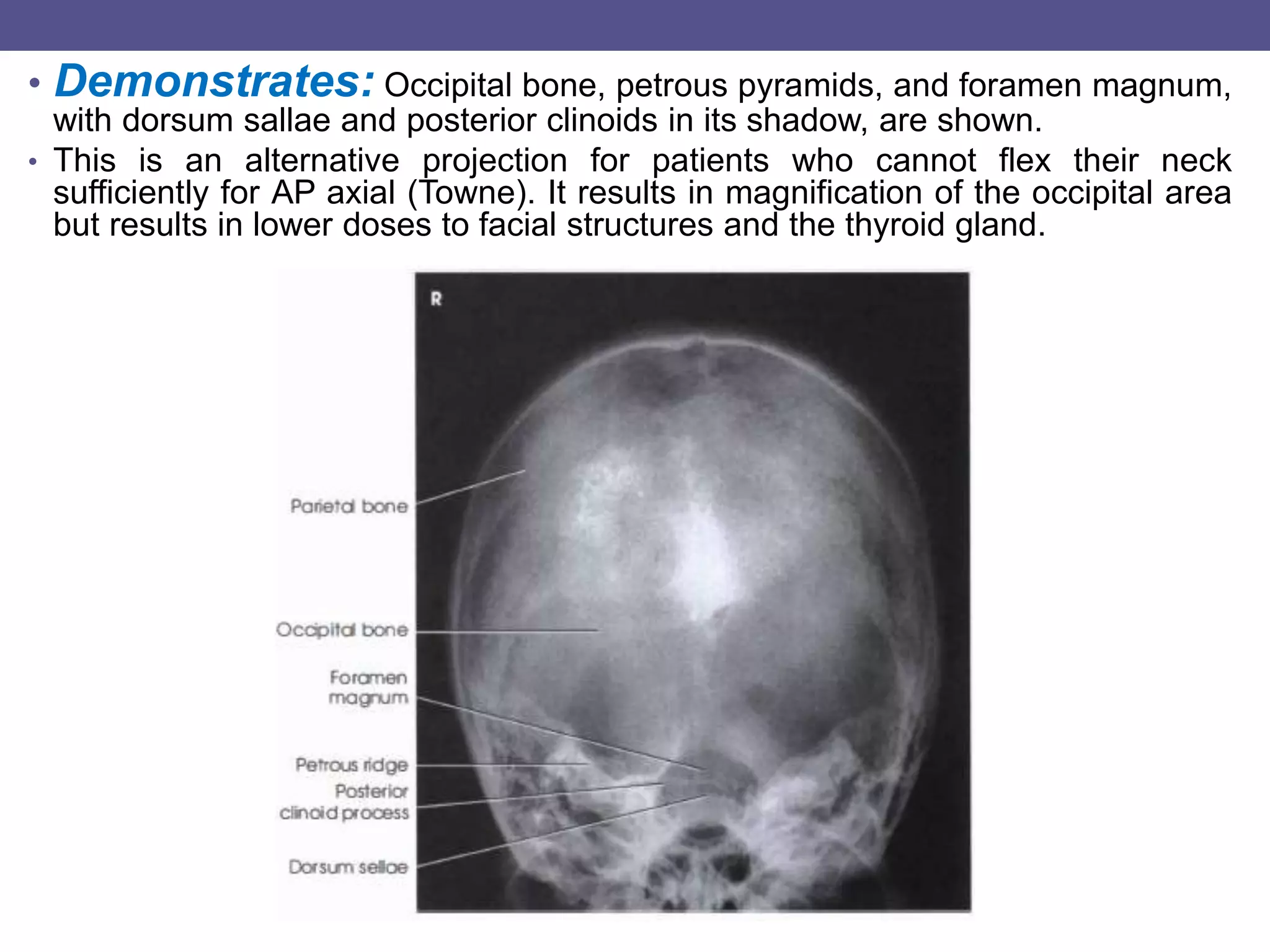 Perous Pyramed Skull, pns views.pot