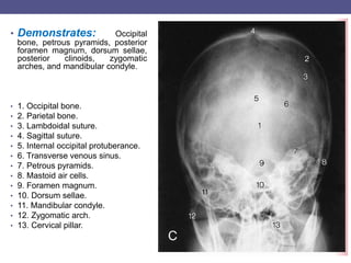 Skull, pns views.pot