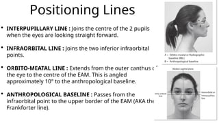 Meatal Line Skull Positioning for radiography techn.pptx
