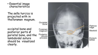 • Essential image
characteristics
The sella turcica is
projected with in
theforamen magnum.
occipital bone and
posterior parts of
parietal bone, and the
lambdoidal suture
should be visualized
clearly.
 