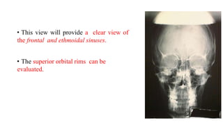 • This view will provide a clear view of
the frontal and ethmoidal sinuses.
• The superior orbital rims can be
evaluated.
 