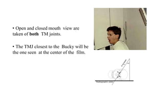 • Open and closed mouth view are
taken of both TM joints.
• The TMJ closest to the Bucky will be
the one seen at the center of the film.
 